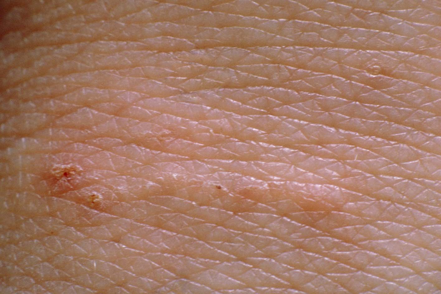 scabies-uk-9.jpeg