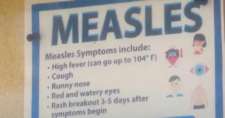 measles-symptoms-97.webp