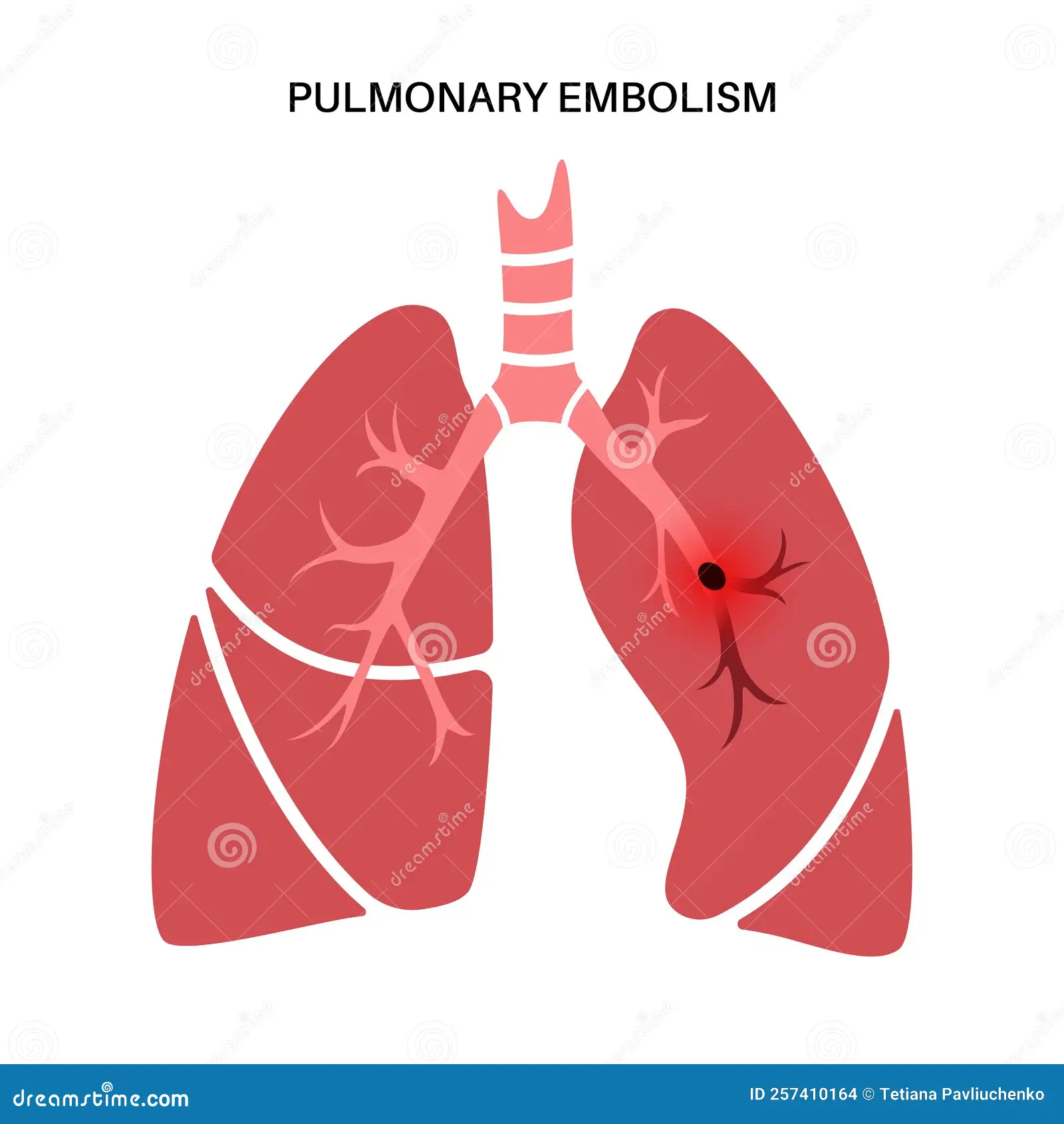 pulmonary-embolism-22.webp